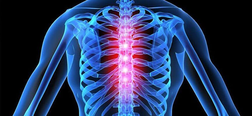 A dor aguda é característica da exacerbación da osteocondrose da columna vertebral torácica