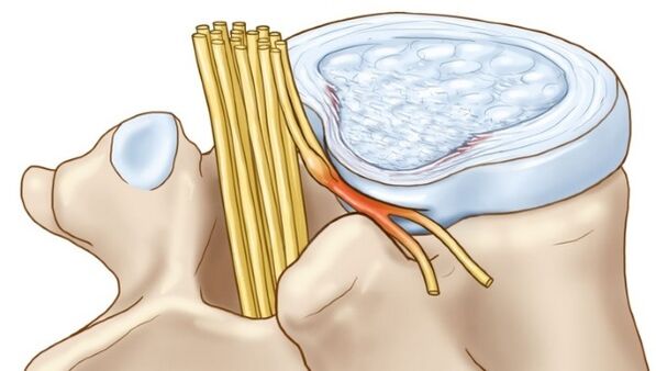 As protuberancias do disco intervertebral, que ocorren na osteocondrose torácica, comprimen as terminacións nerviosas