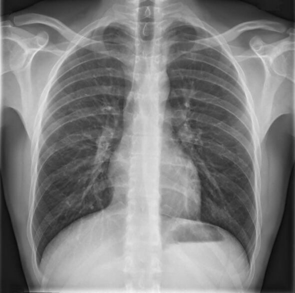 O diagnóstico da osteocondrose da columna vertebral torácica realízase mediante raios X