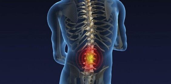 Dor nas costas con osteocondrose da columna lumbar