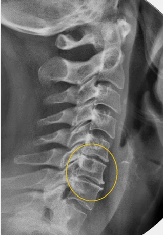 Osteocondrose da columna cervical nunha x raios