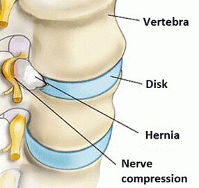 Osteocondrose da rexión do cérvix