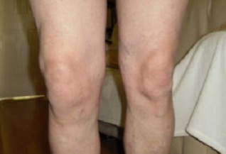 Manifestacións de artrose da articulación do xeonllo (1)