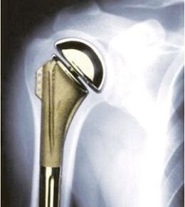 Reemplazo de ombreiro para osteoartrite