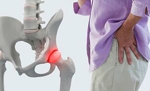 Causas da artrose na articulación da cadeira