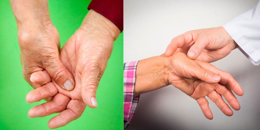 O inchazo e a dor dolorida son os primeiros signos de artrose manual