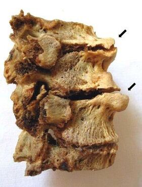 Sección das vértebras afectada por osteocondrose