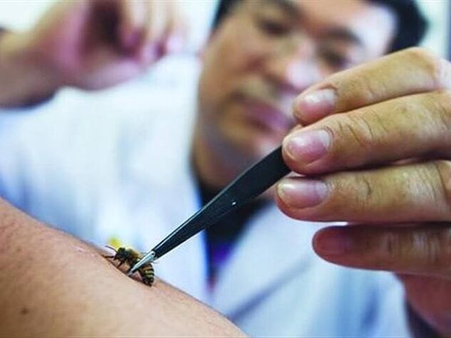 Apiterapia para osteocondrosis cervical