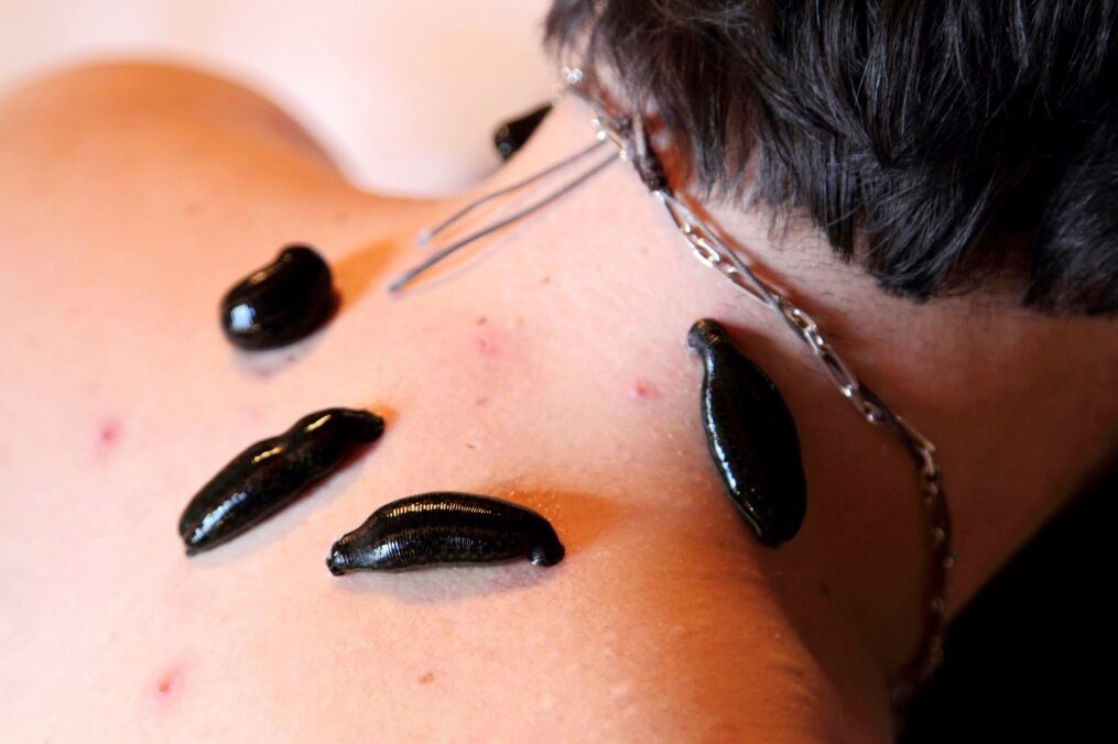 Sanguixas para osteocondrose cervical