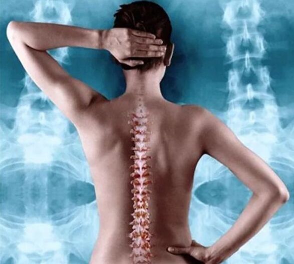Osteocondrose da columna vertebral e torácica