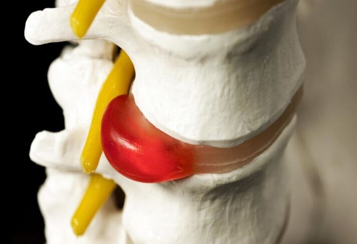 Hernia espinal como causa de dor nos omóplatos